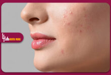 روش های جدید و موثر برای از بین بردن لک های صورت با درمان های پزشکی و طبیعی