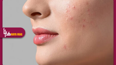 روش های جدید و موثر برای از بین بردن لک های صورت با درمان های پزشکی و طبیعی