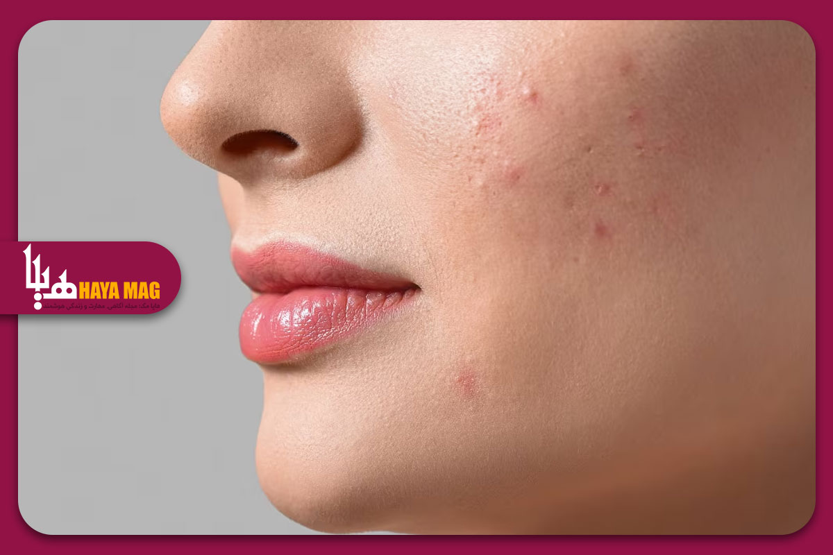 روش های جدید و موثر برای از بین بردن لک های صورت با درمان های پزشکی و طبیعی